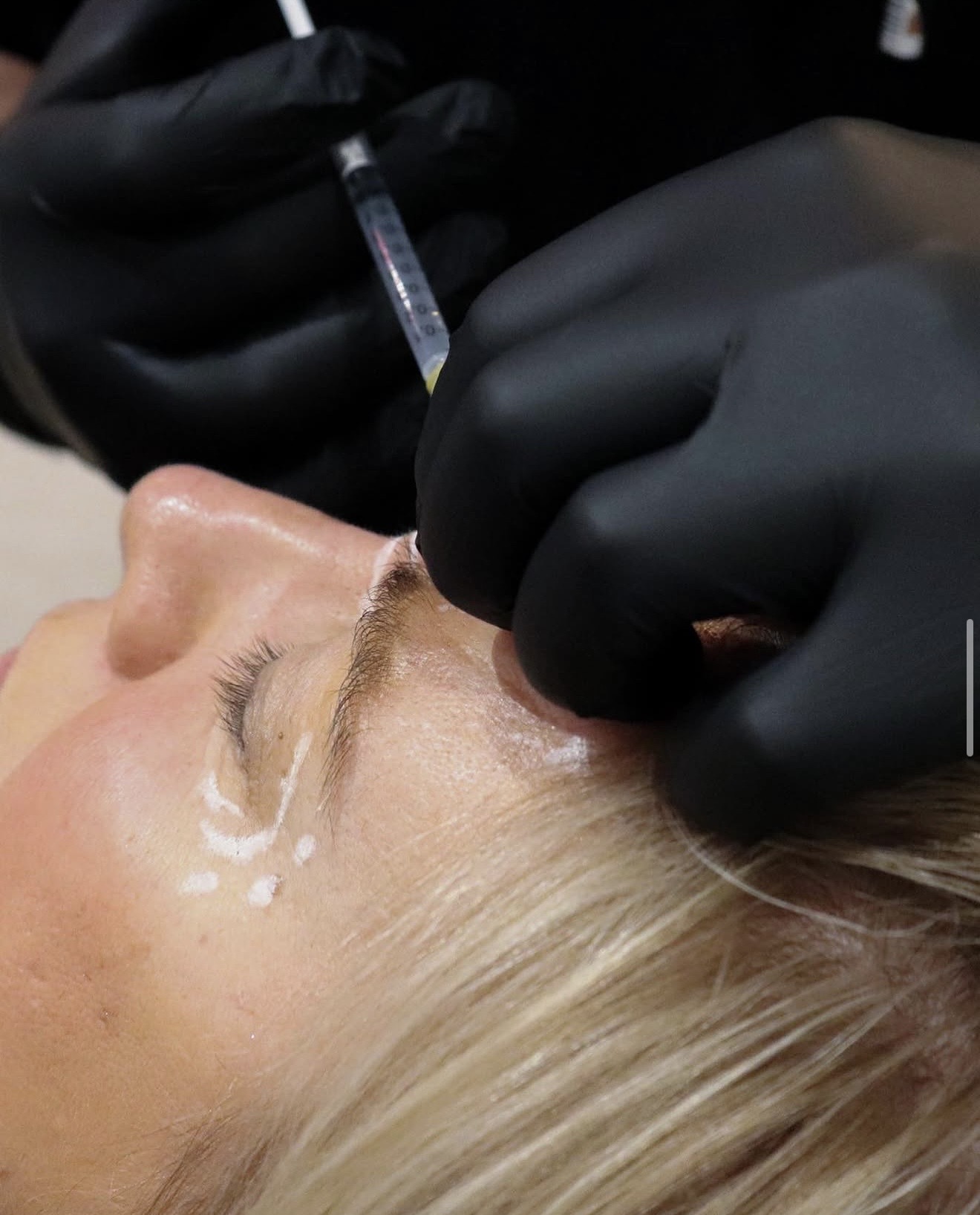 Aephelion practitioner working on a brow-area treatment with a fine-gauge needle, gloved hands steady
