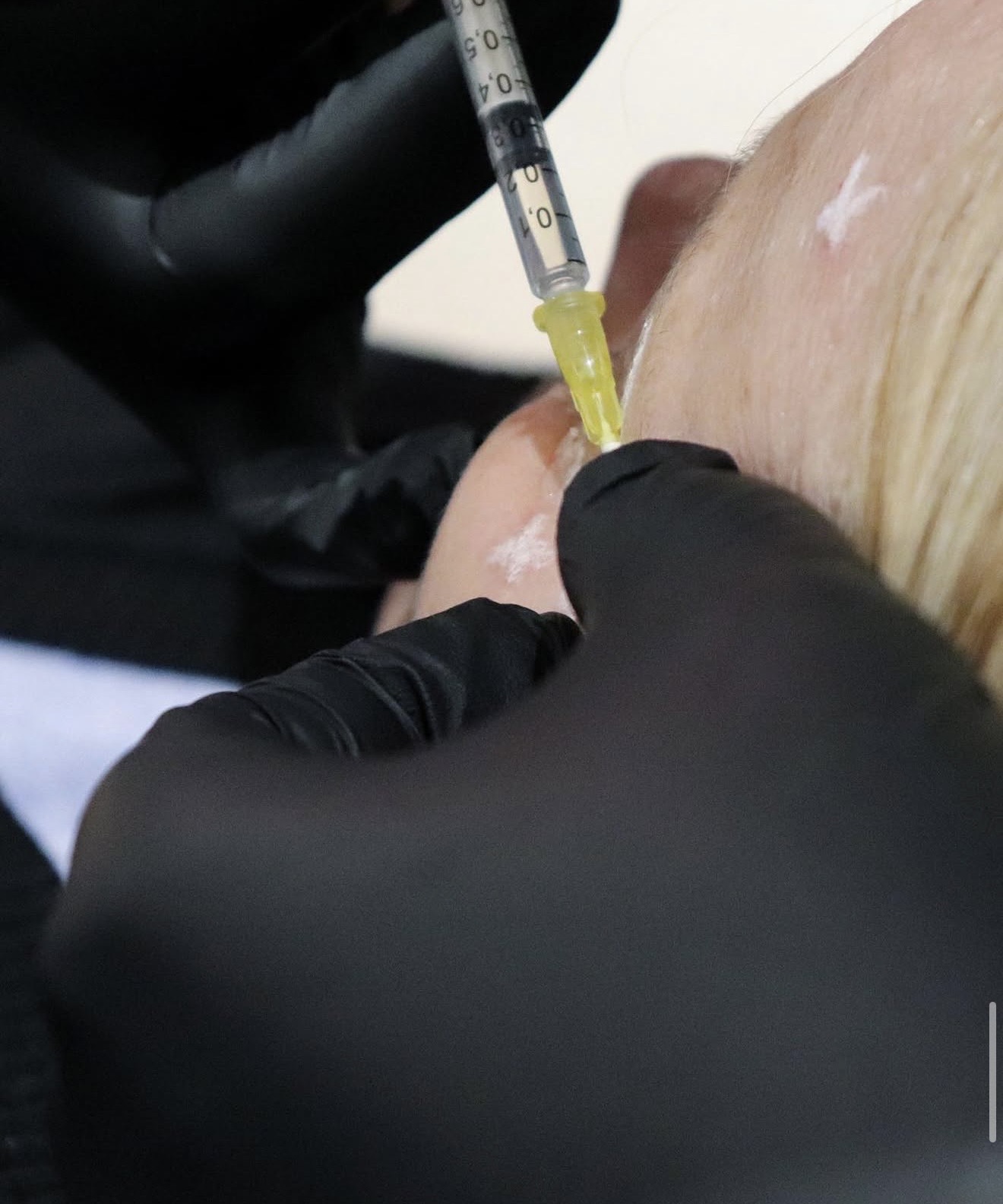 Aephelion practitioner performing a precise lip treatment, gloved hands holding a fine-gauge needle